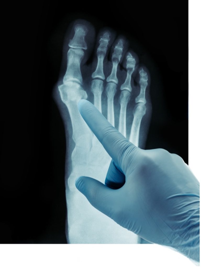 Defective Cartiva Toe Implant 